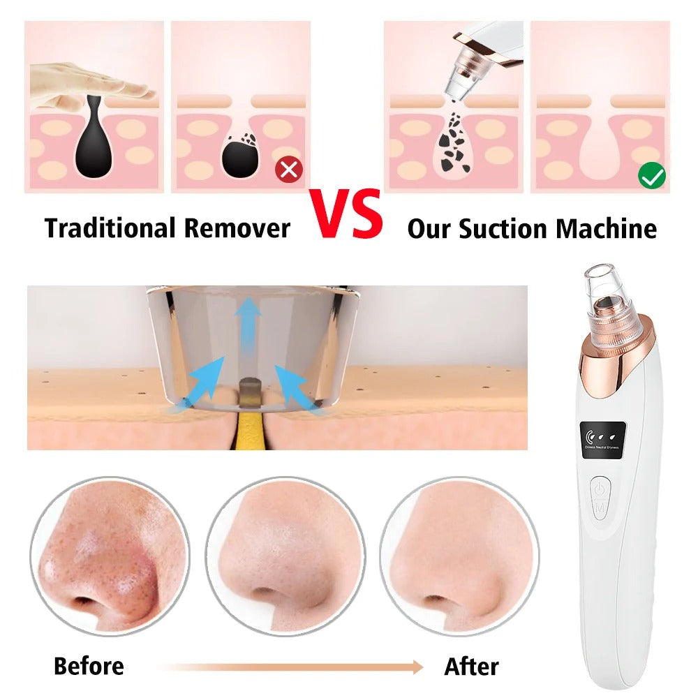Electric Blackhead Remover Vacuum – Professional Pore Cleaner & Acne Removal Kit